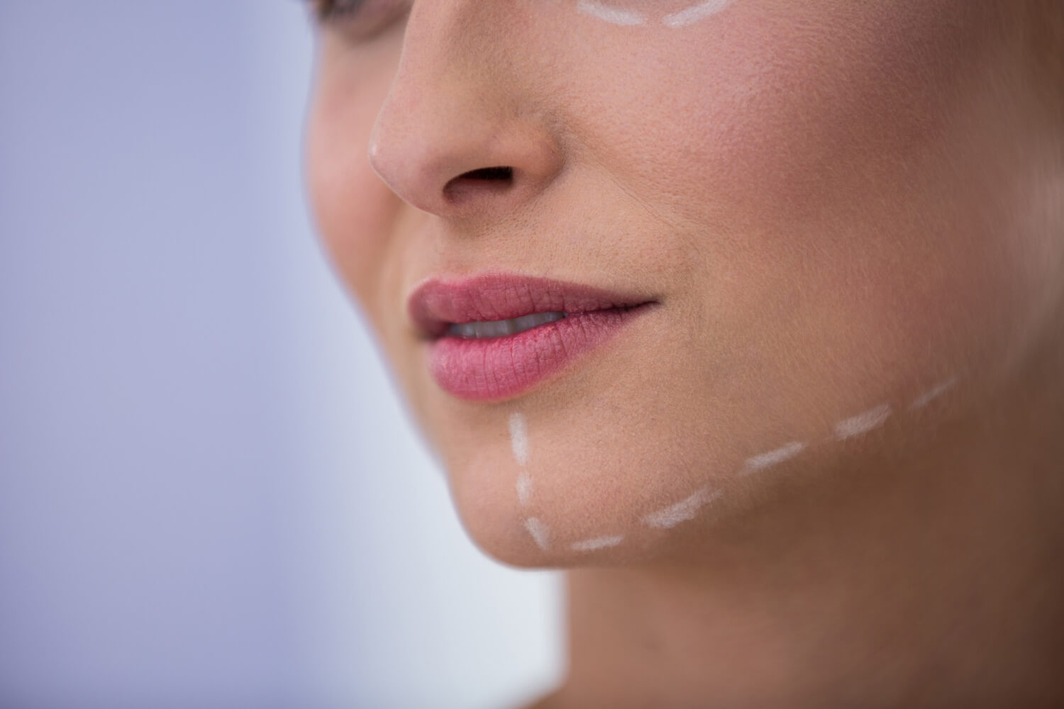 Close do rosto de uma paciente com marcações cirúrgicas brancas no queixo e mandíbula para harmonização orofacial em Feira de Santana.