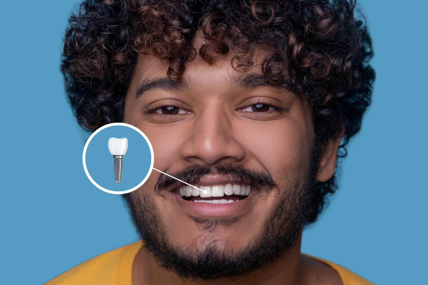 Homem sorrindo com ilustração de implante dentário em destaque sobre um dente frontal. Referência em implantes dentários em Feira de Santana.