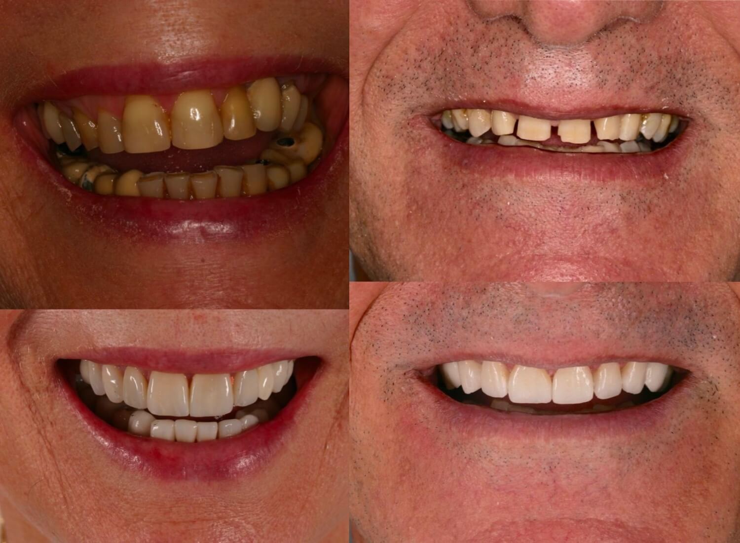 Antes e depois lentes de contato dental