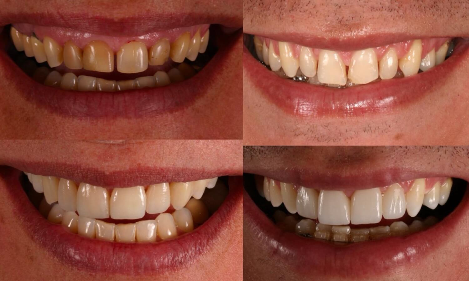 Antes e depois lentes de contato dental